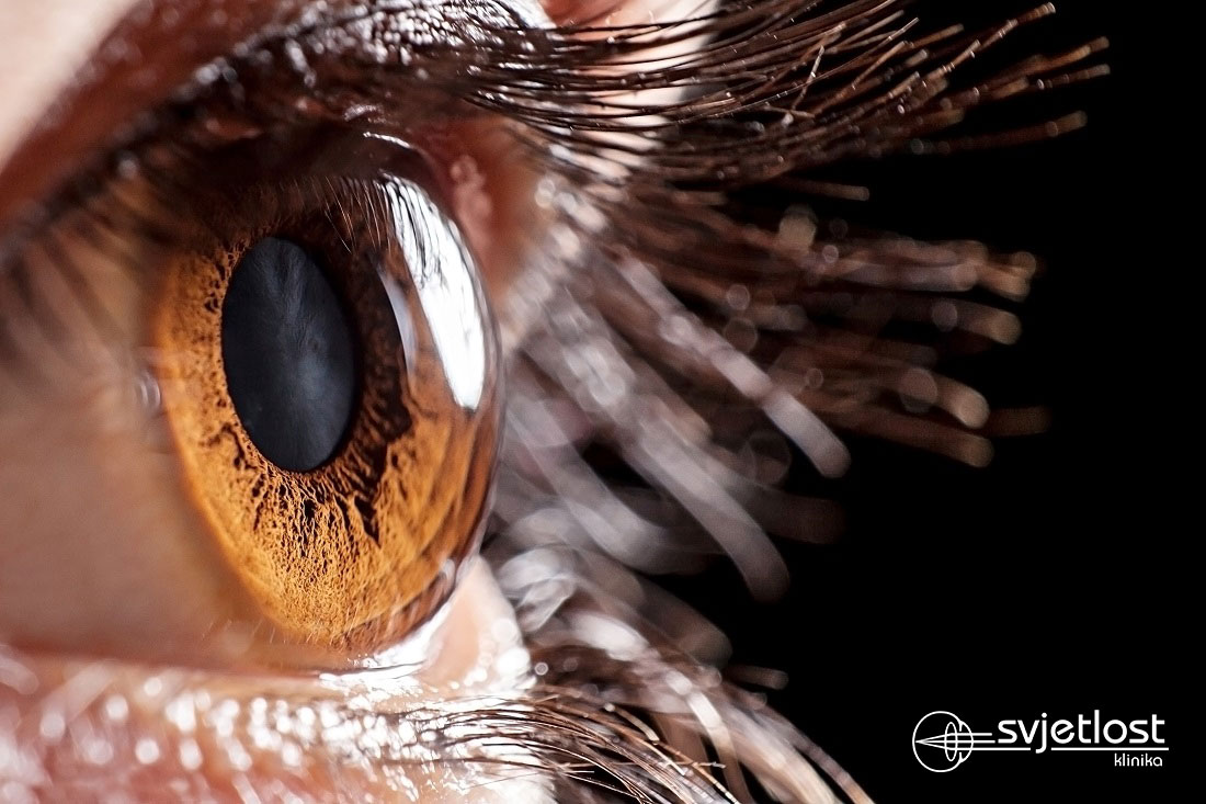 Mlađi ste od 35, dioptrija vam se stalno mijenja i nikako ne postižete oštrinu vida kakvu ste imali ranije?