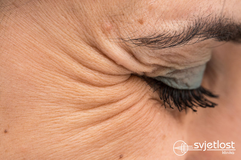 Did you know that wrinkles around the eyes are the first sign of ageing?