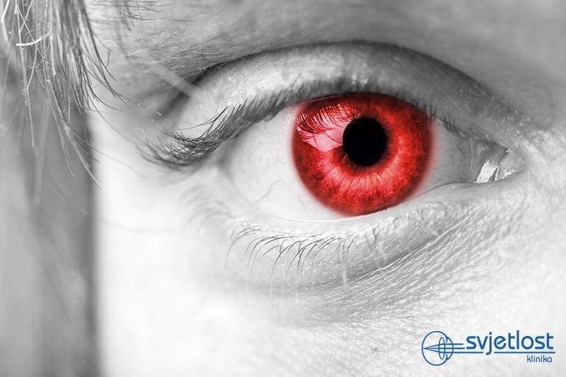 Do you know about medical importance of “red eyes effect” in the photos?