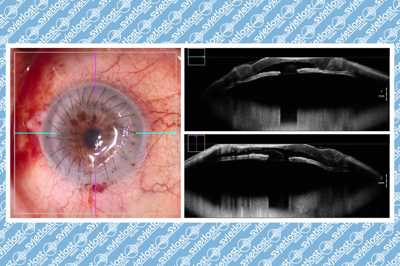 Corneal Transplantation
