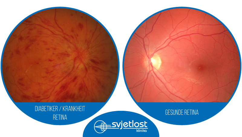 Prädiabetes - was ist das?