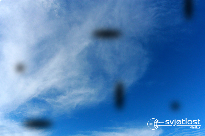 Tamne zavjese, mrljice i bljeskovi u očima - kada se hitno javiti oftalmologu?