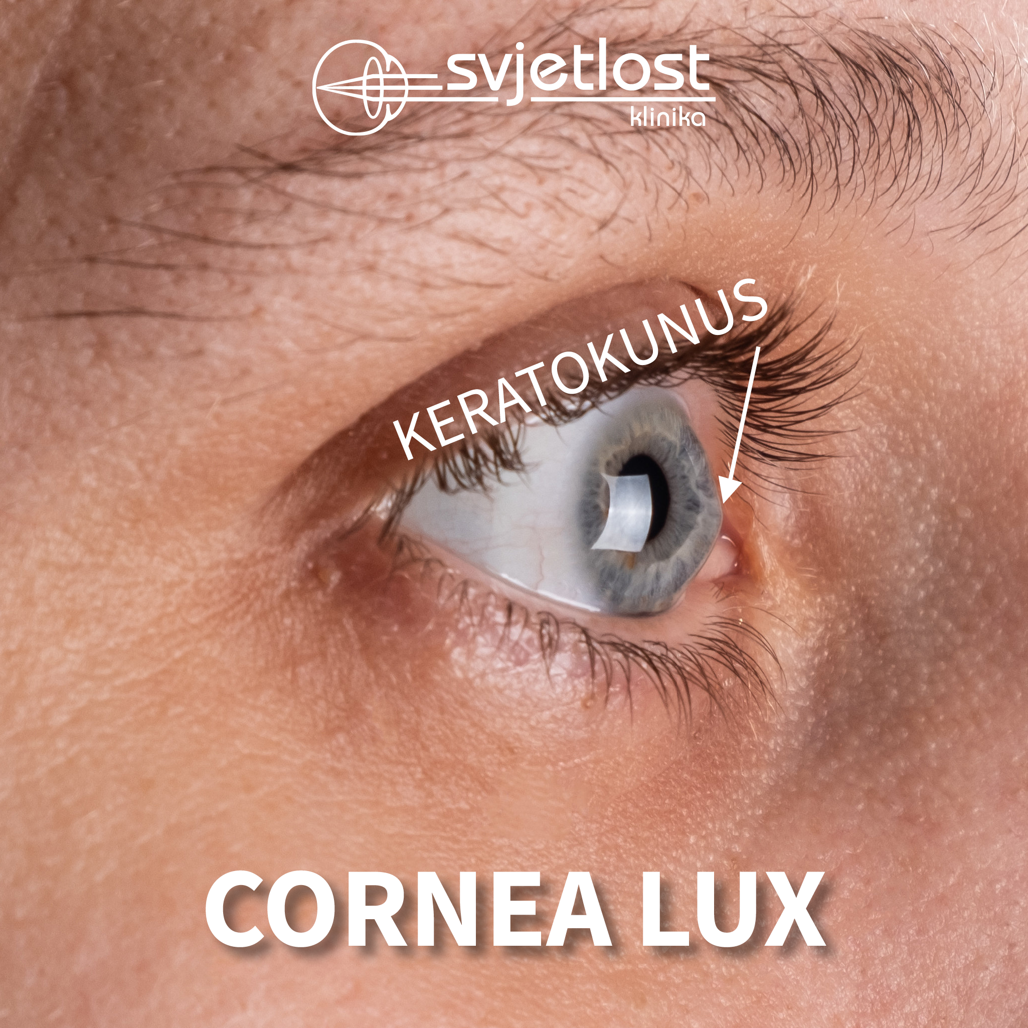 Miss Universe Croatia in der Klinik Svjetlost operiert